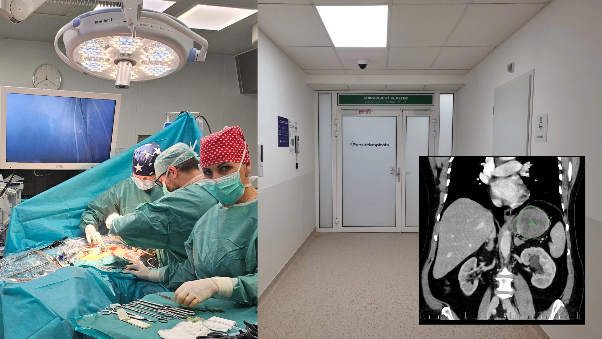 Snímka z operačnej sály počas laparoskopického zákroku a CT vyšetrenie nádoru